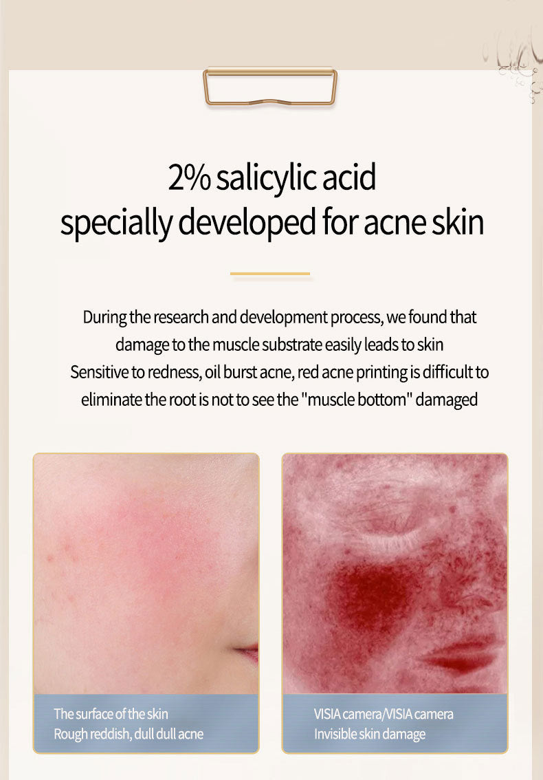 Salicylic Acid Acne Treatment – Effective Acne Removing Skincare Solution