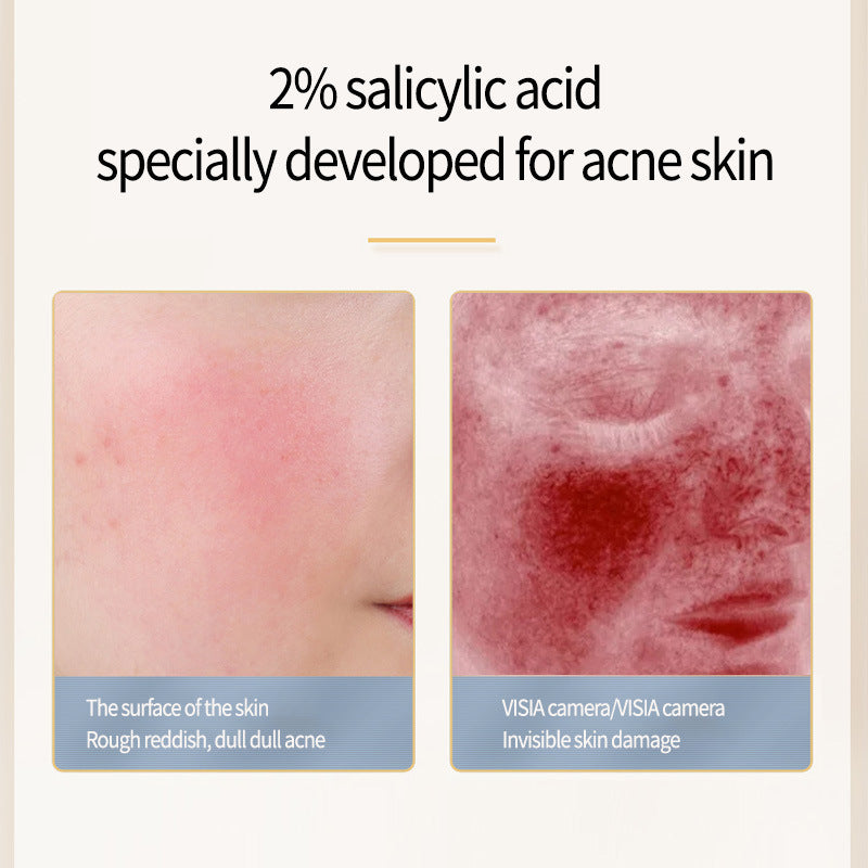 Salicylic Acid Acne Treatment – Effective Acne Removing Skincare Solution