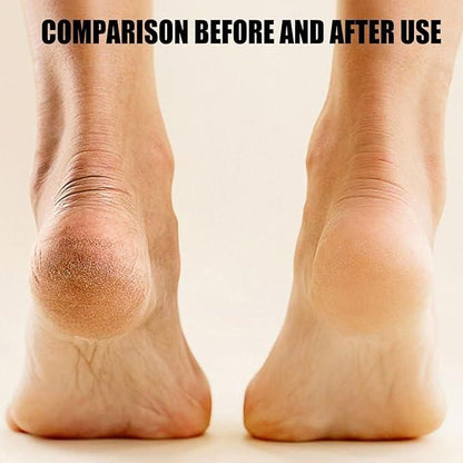 Electronic Pedicure Tool – Electric Callus Remover for Smooth, Soft Feet | Gentle Foot Care at Home